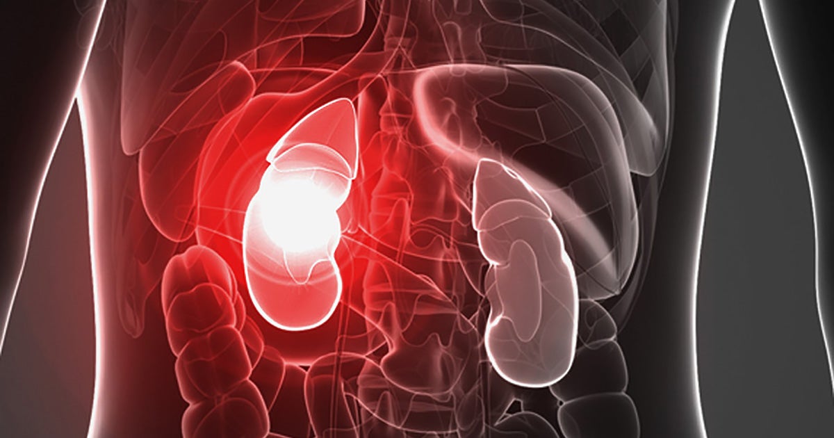 presentation about kidney failure